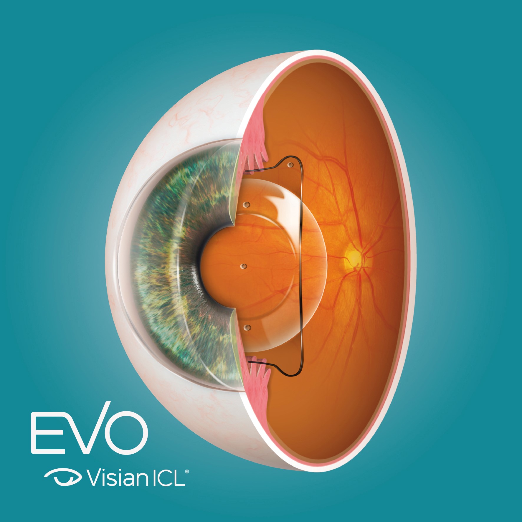 EVO Visian ICL en ojo anatómico